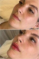 Relleno de labios - Dr. Gustavo Godoy