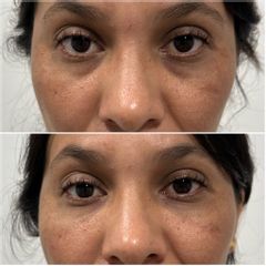 Eliminación de ojeras - Dr. Gustavo Godoy