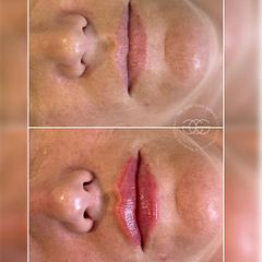 Relleno de labios - Dr. Gustavo Godoy