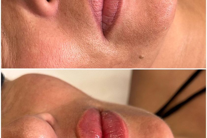 Relleno de labios antes y después - 865960