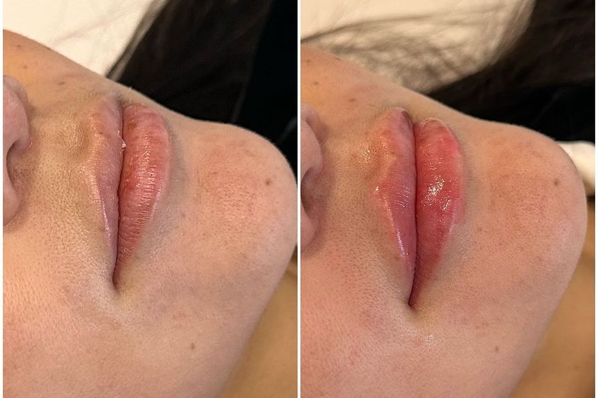 Relleno de labios antes y después - 870340