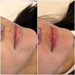 Relleno de labios - Dr. Gustavo Godoy