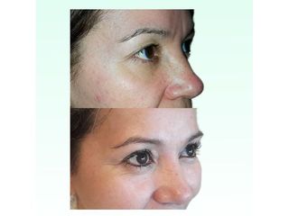 Blefaroplastia - Dra. Laura Marin