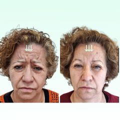 Toxina Botulínica - Dra. Laura Marin
