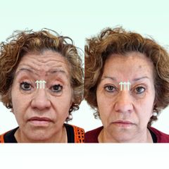 Toxina Botulínica - Dra. Laura Marin