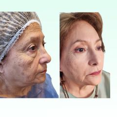 Blefaroplastia - Dra. Laura Marin