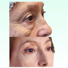 Blefaroplastia - Dra. Laura Marin