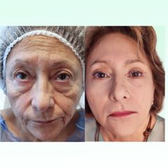 Blefaroplastia - Dra. Laura Marin