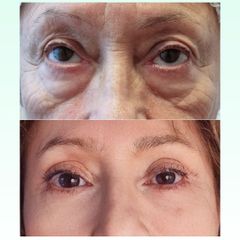 Blefaroplastia - Dra. Laura Marin