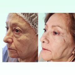 Blefaroplastia - Dra. Laura Marin