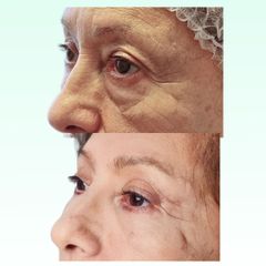 Blefaroplastia - Dra. Laura Marin