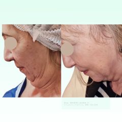 Liposucción de papada - Dra. Laura Marin