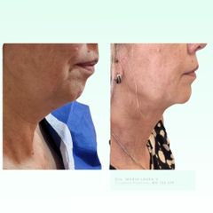 Liposucción de papada - Dra. Laura Marin