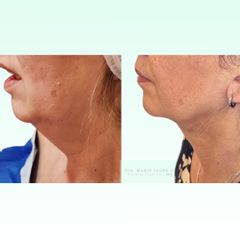 Liposucción de papada - Dra. Laura Marin