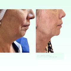 Liposucción de papada- Dra. Laura Marin