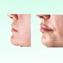 Relleno de labios - Dra. Laura Marin