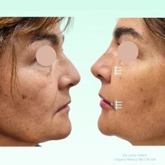 Rellenos faciales - Dra. Laura Marin