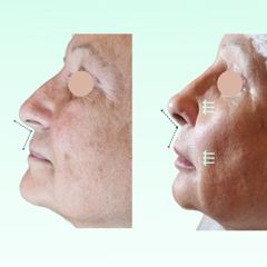 Rellenos faciales - Dra. Laura Marin