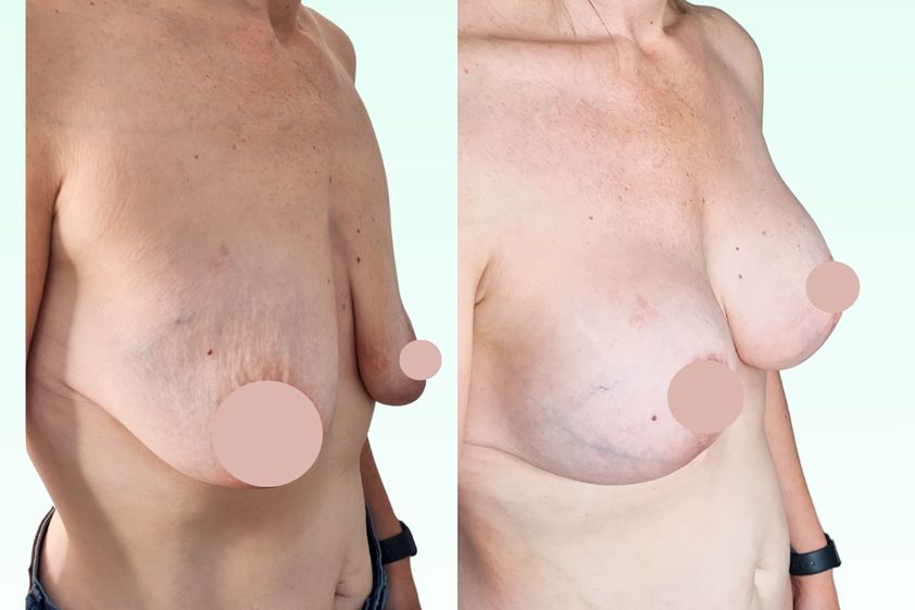 Mastopexia antes y después - 870889