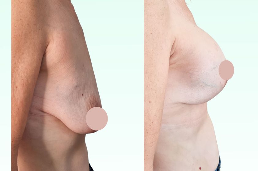Mastopexia antes y después - 870891