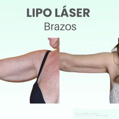 Lipoláser brazos - Dra. Laura Marin