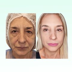 Blefaroplastia - Dra. Laura Marin