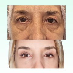 Blefaroplastia - Dra. Laura Marin