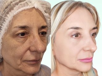 Blefaroplastia antes y después - 870898