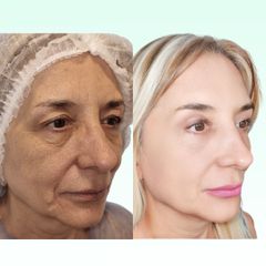 Blefaroplastia - Dra. Laura Marin