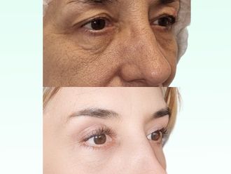 Blefaroplastia antes y después - 870899