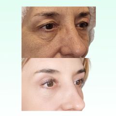 Blefaroplastia - Dra. Laura Marin