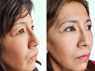 Blefaroplastia antes y después - 871025