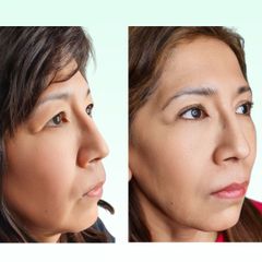 Blefaroplastia - Dra. Laura Marin