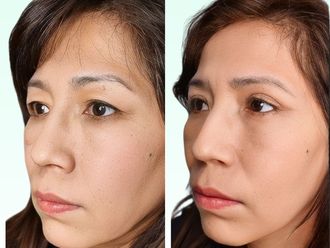 Blefaroplastia antes y después - 871029