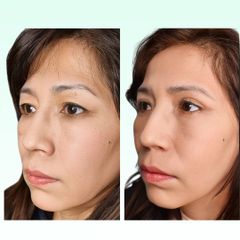 Blefaroplastia - Dra. Laura Marin