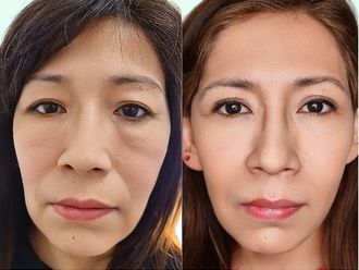 Blefaroplastia antes y después - 871030