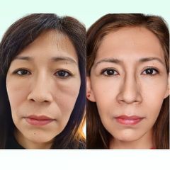 Blefaroplastia - Dra. Laura Marin