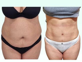 Dermolipectomía antes y después - 880275