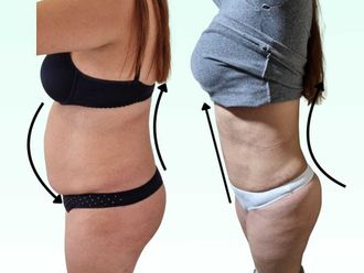 Dermolipectomía antes y después - 880277