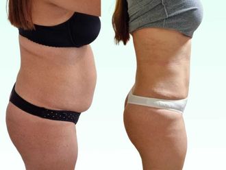 Dermolipectomía antes y después - 880278