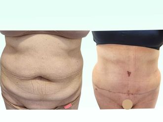 Dermolipectomía antes y después - 880346