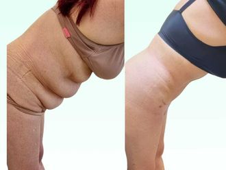 Dermolipectomía antes y después - 880347