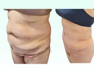 Dermolipectomía antes y después - 880348