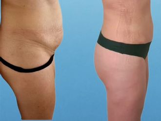 Abdominoplastía antes y después - 881178