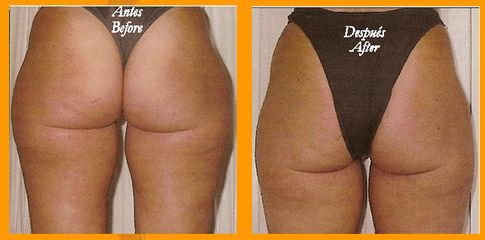 Hidrolipoclasia