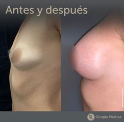 Aumento mamas  - Desthetic