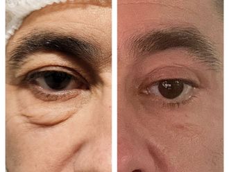 Blefaroplastia antes y después - 869854