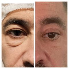 Blefaroplastia - Estética Delger