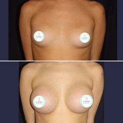 Aumento mamas - Dr. Williams Erik Bukret