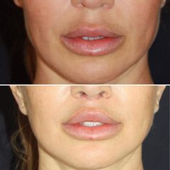 Lifting de labios - Dr. Williams Erik Bukret